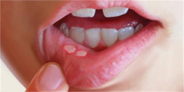 چگونه آفت دهان را درمان کنیم