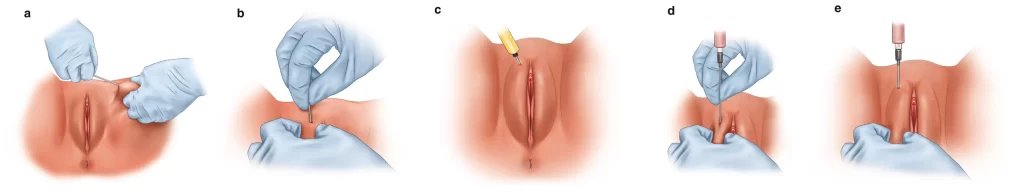 ماندگاری تزریق چربی به واژن