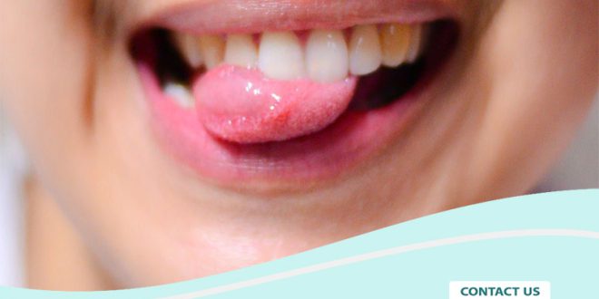زخم روی زبان را چگونه درمان کنیم؟