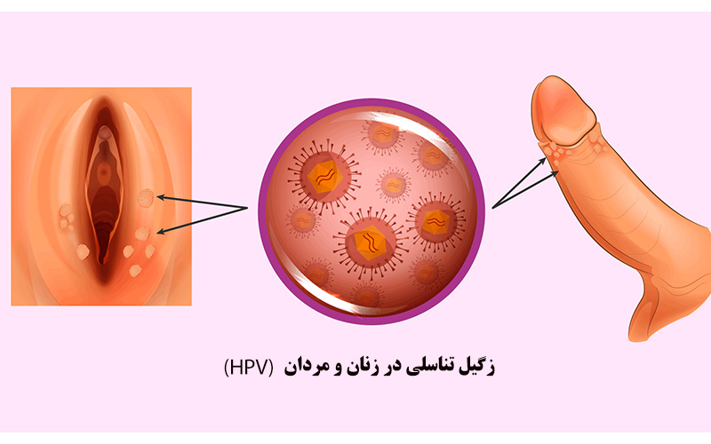 علائم پاپول مرواریدی زنانه